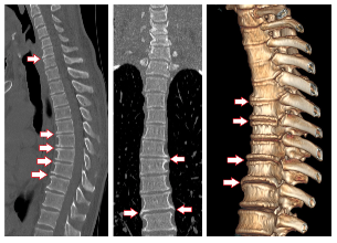 the symptoms of degenerative disc disease