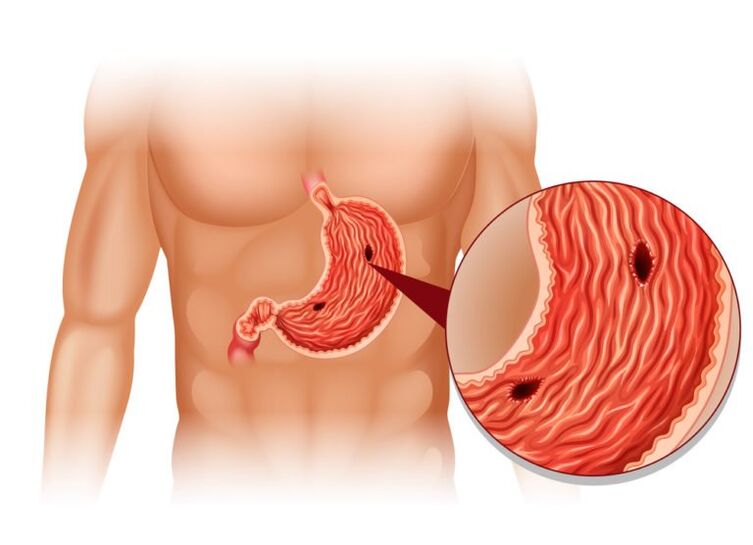 ulcer as a cause of pain under the left scapula behind