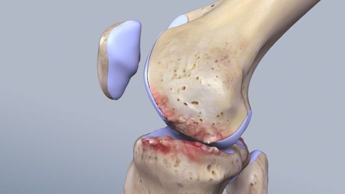 The structure of the knee joint affected by pathology. 