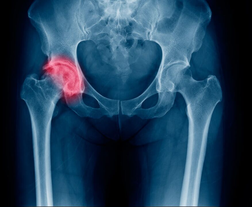 Fracture of the femoral neck, causing pain that radiates to the leg. 