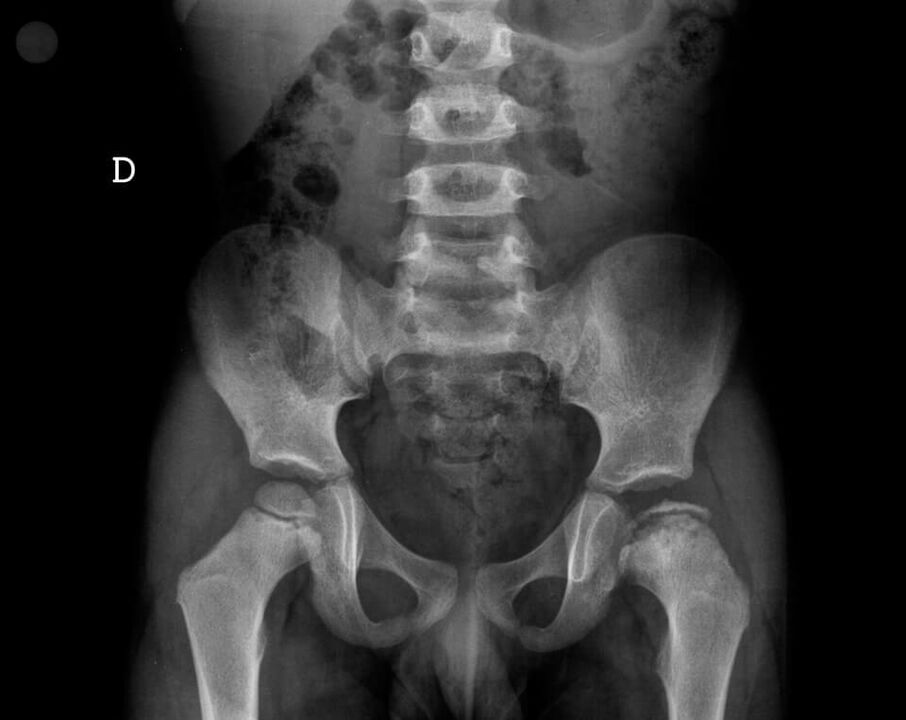 Legg-Calvé-Perthes disease necrosis of the cartilage tissue of the femoral head