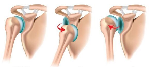 Anterior and posterior dislocation of the shoulder joint, causing the development of osteoarthritis. 