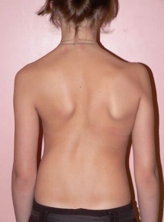 SCOLIOSIS 2 degrees