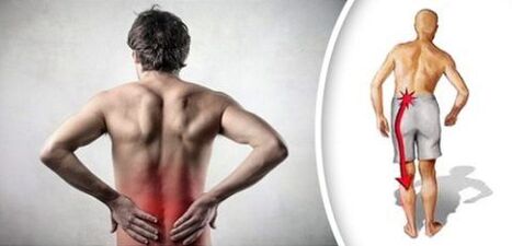 Pain syndrome with lumbar osteochondrosis radiates on the legs