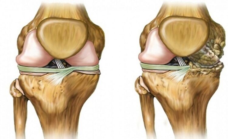 Healthy and affected by joint osteoarthritis