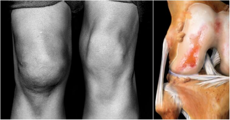 Knee joint osteoarthritis and joint pain
