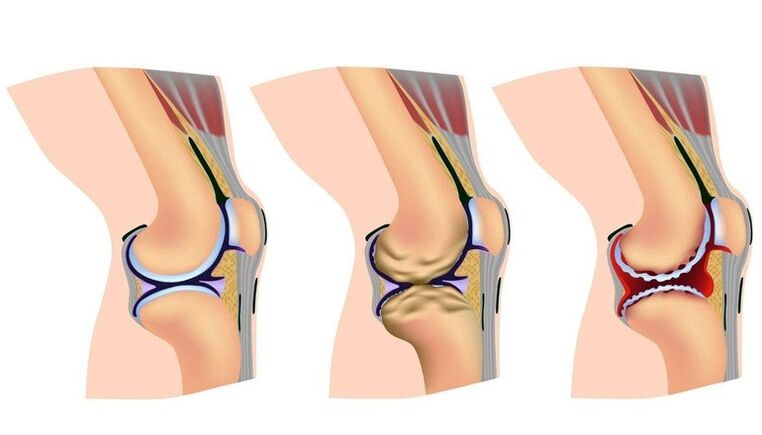 Stages of deformation in the knee joint for osteoarthritis