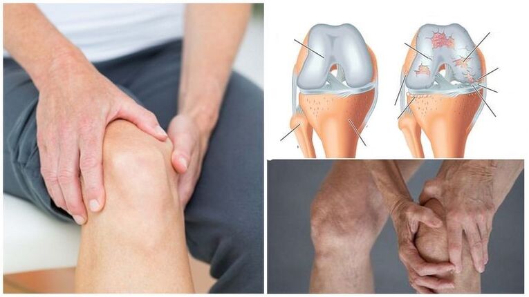Symptom of osteoarthritis knee paint of the knee joint