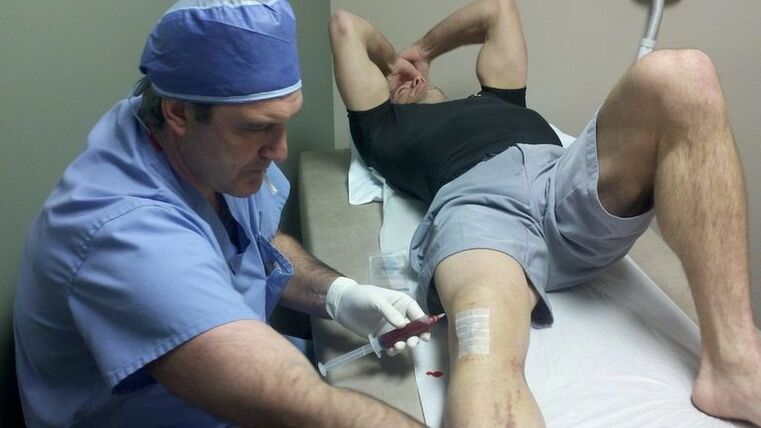 Treatment of knee joint osteoarthritis