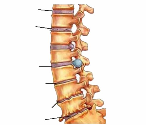 Damage to the spine causes back pain.