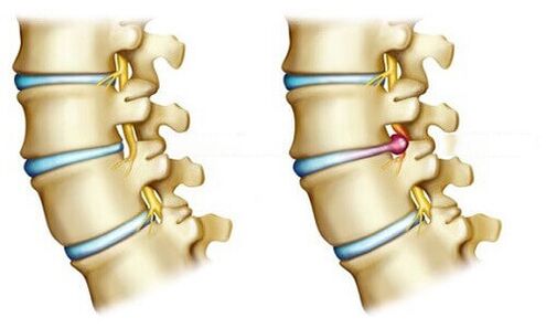 herniated disc and healthy disc