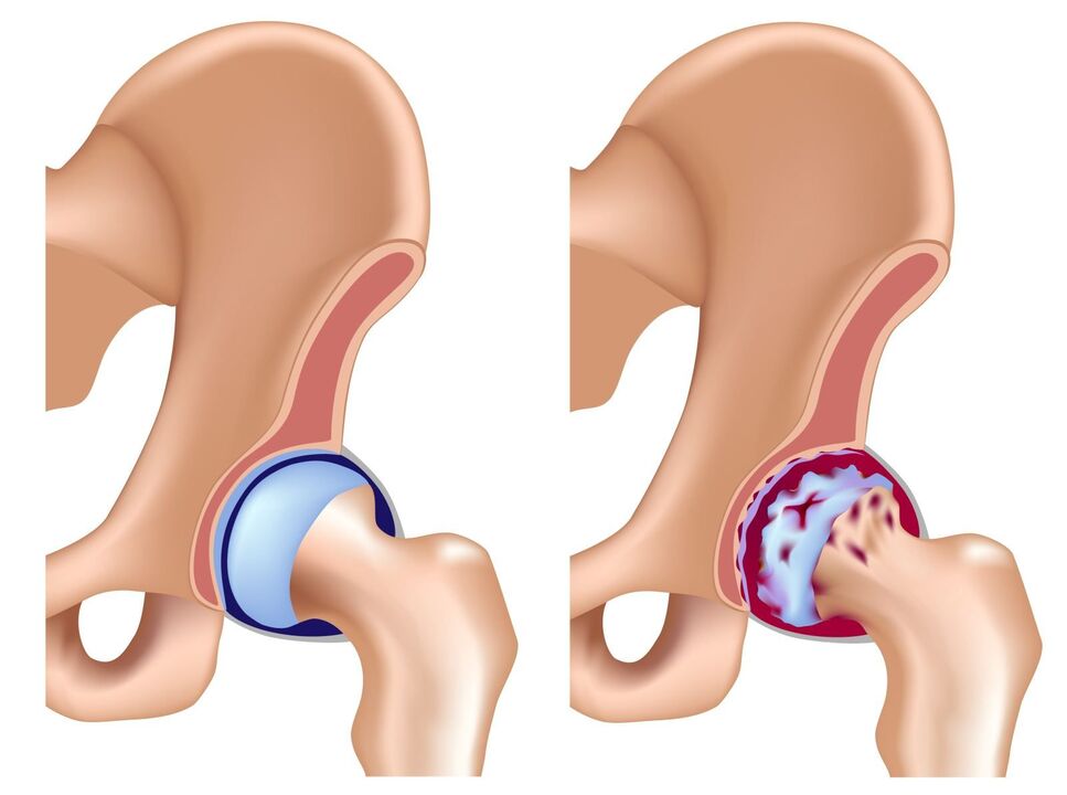 comparison of a healthy joint and osteoarthritis