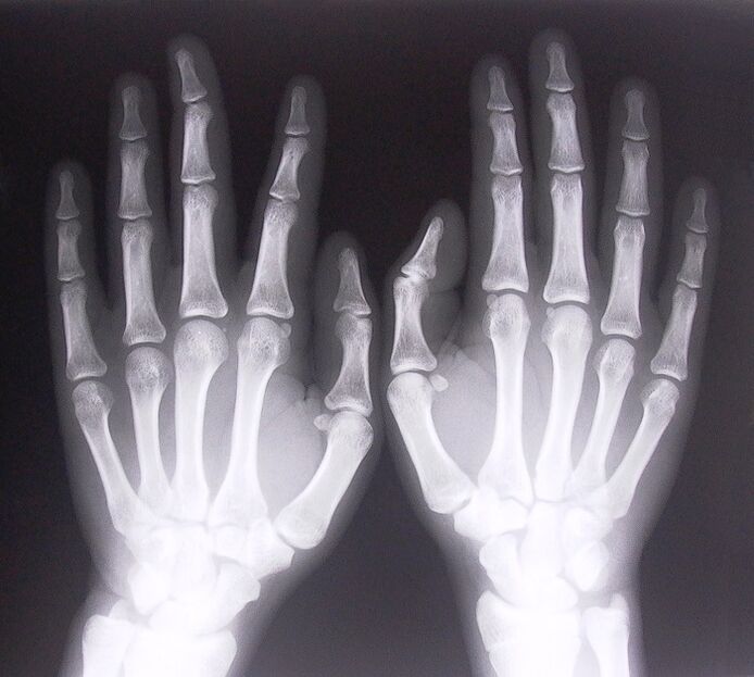 X-ray as a way to diagnose finger joint pain.