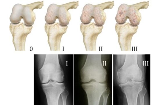 methods to diagnose knee osteoarthritis