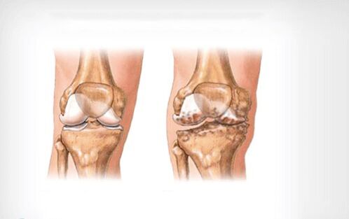 osteoarthritis of the knee joint