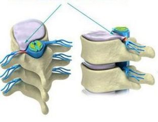 the formation of a hernia