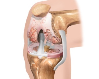 the scheme of osteoarthritis